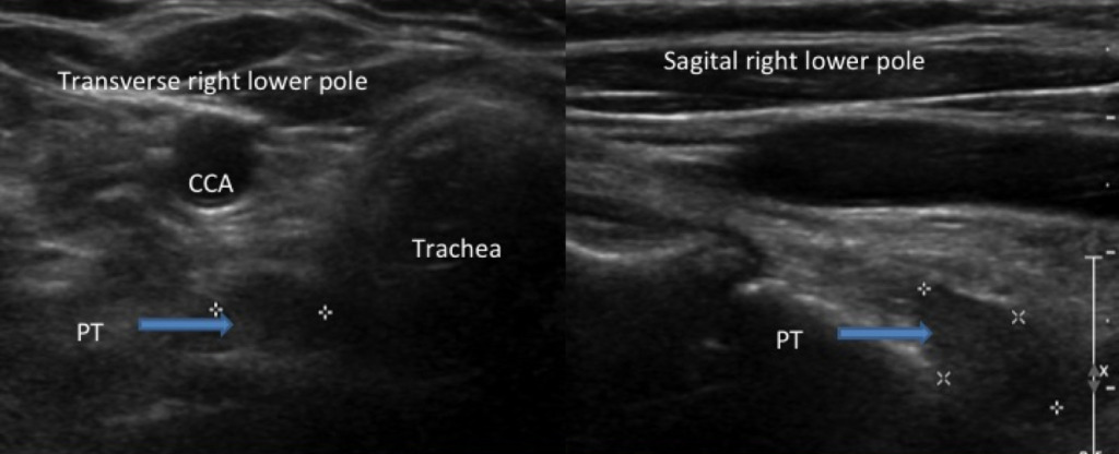 parathyroid ultrasound Archives - Peter M. Mowschenson, MD