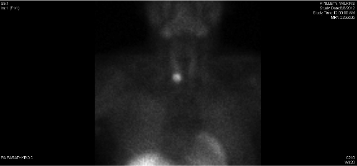 Sestamibi Scanning